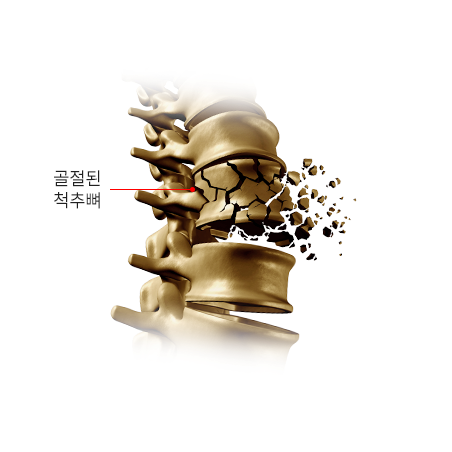골절된 척추뼈